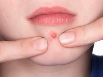 Resultado de imagem para acne infantil